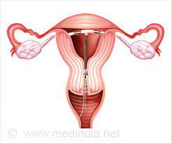 iud
